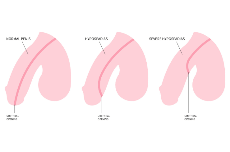 Hypospadias Repair